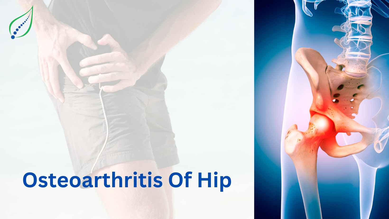 Hip Osteoarthritis